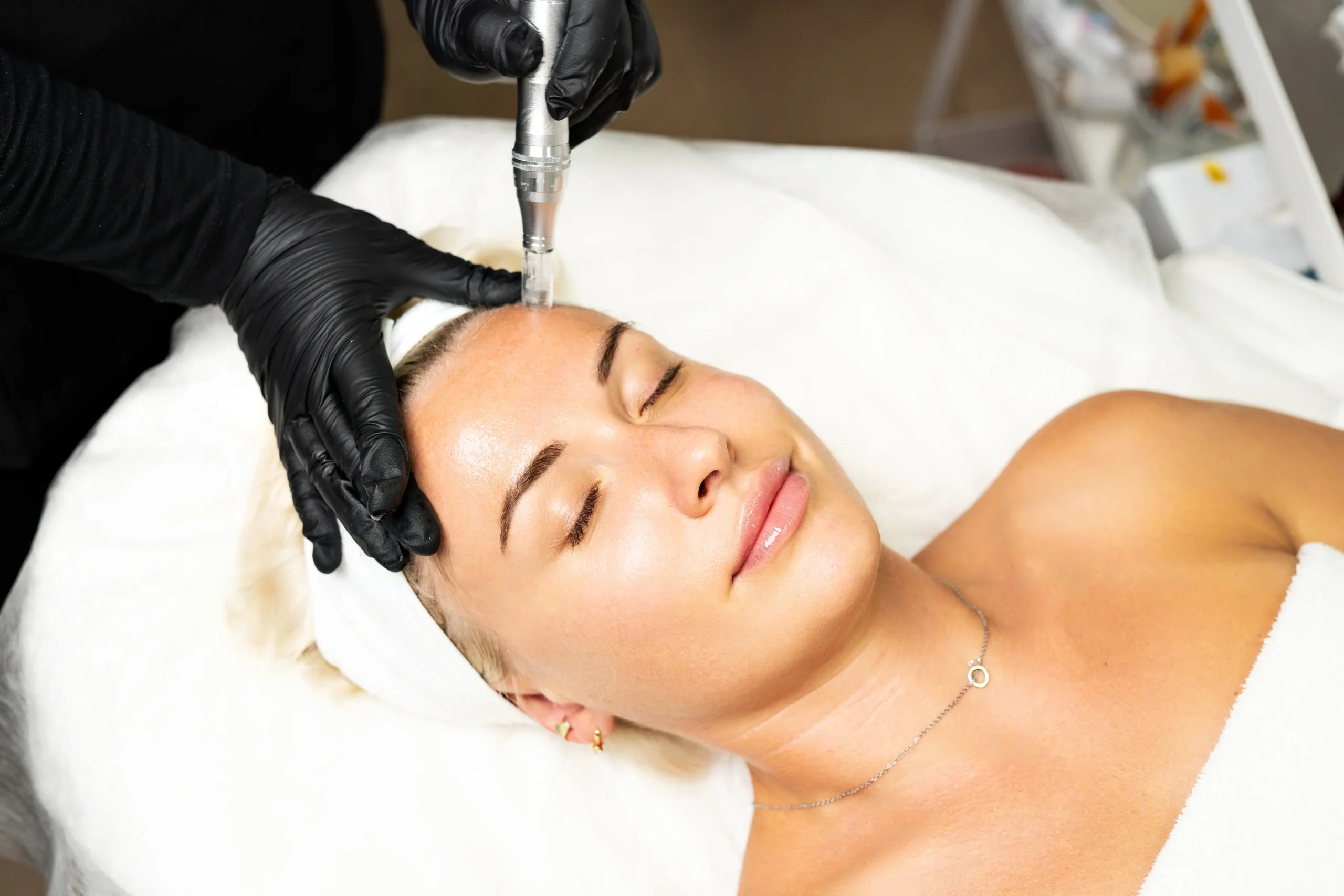Microneedling treatment in Madison, Alabama | Nava Medical Aesthetics