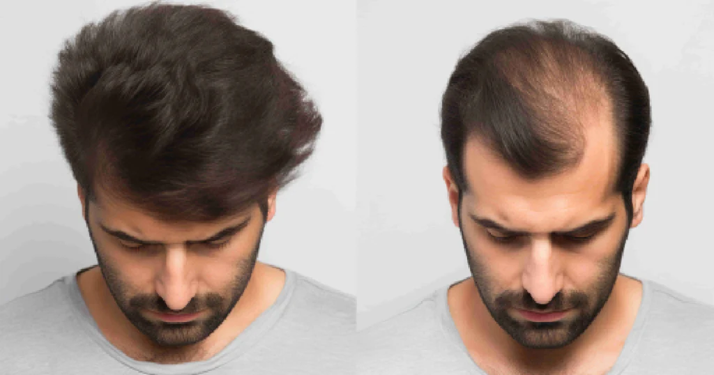 A before-and-after image of a man's head, showing hair loss, highlighting Hair Restoration in Madison, AL.