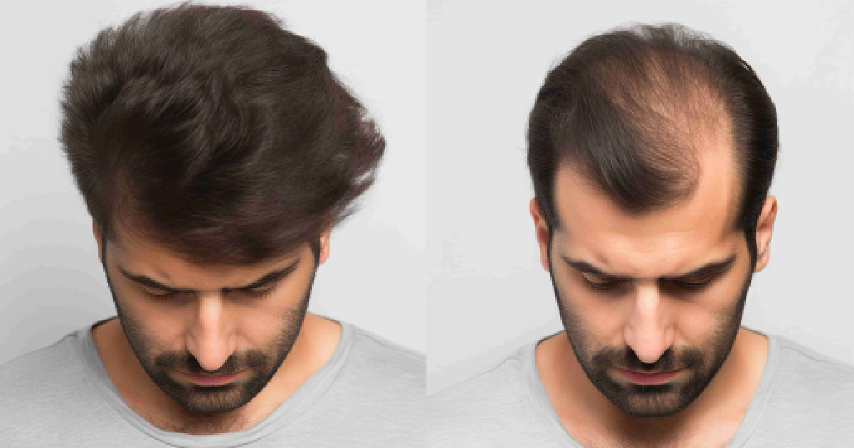A before-and-after image of a man's head, showing hair loss, highlighting Hair Restoration in Madison, AL.