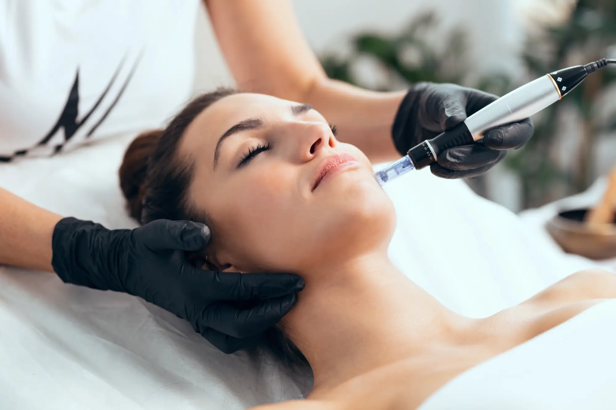 Microneedling in Madison, AL by Nava Medical Aesthetics